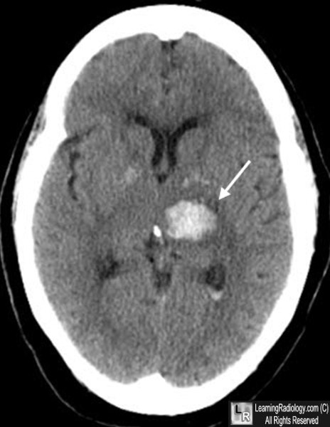 Intracerebral hemorrhage